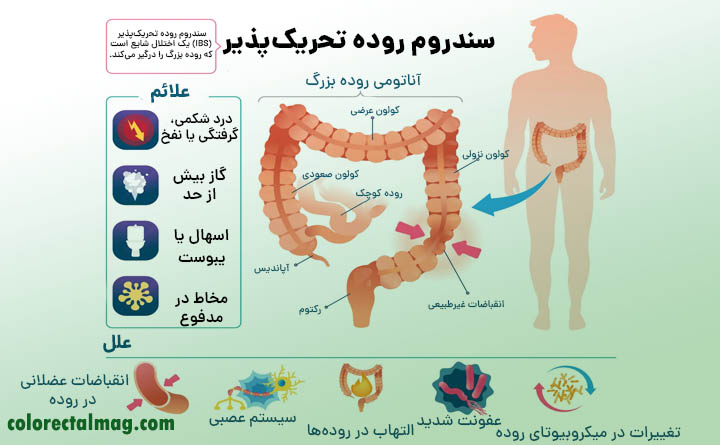 سندروم روده تحریک پذیر 