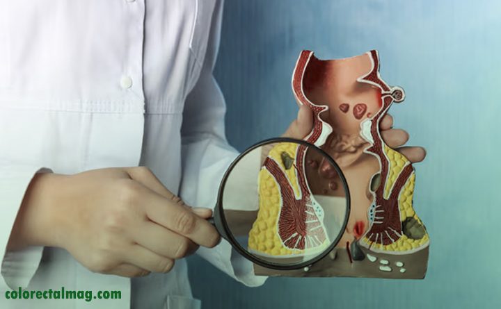 آبسه مقعدی و خونریزی مقعدی