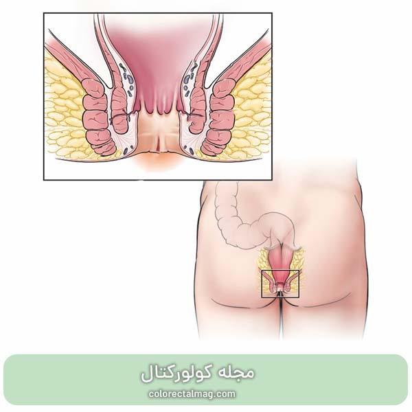 شقاق مقعد چیست؟ علائم شقاق و نحوه درمان فیشر