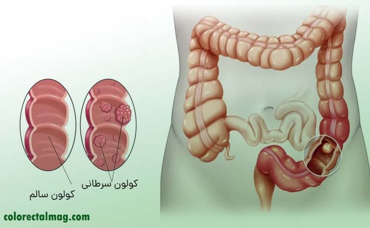 سرطان روده