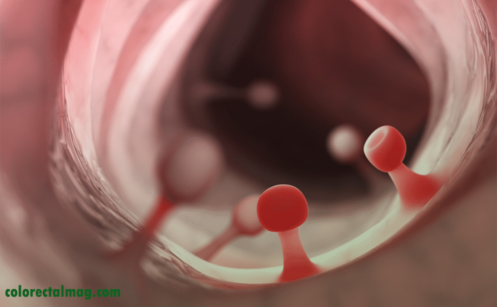 انواع پولیپ روده