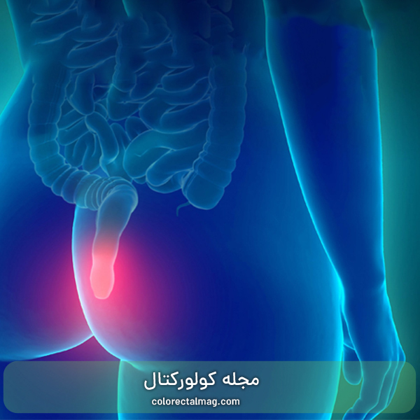 15 علت خونریزی مقعدی هنگام دفع مدفوع با درد و بدون درد!
