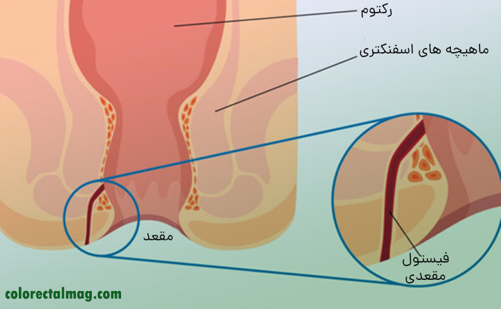 فیستول مقعدی