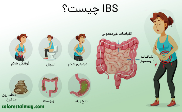 سندروم روده تحریک پذیر