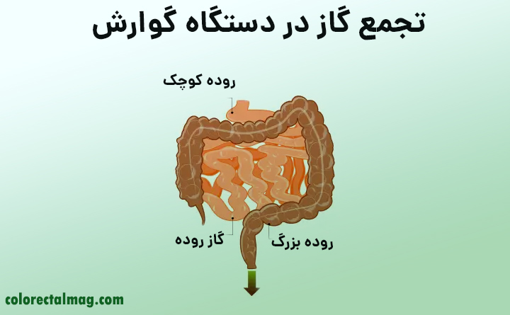 باد معده خطرناک است؟