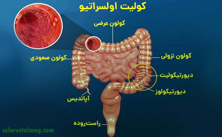 کولیت چیست؟