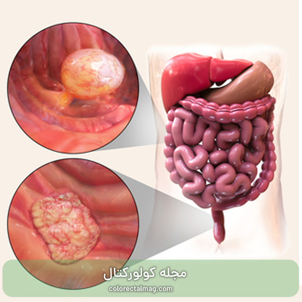 پولیپ روده چیست؟ از کجا بفهمیم پولیپ روده داریم؟