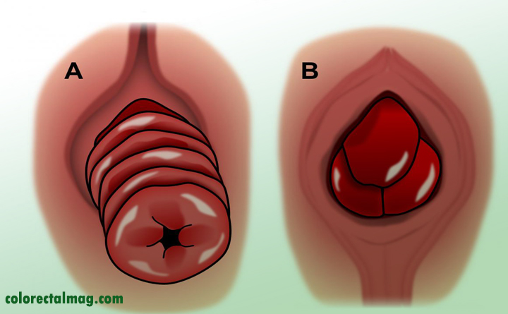 بیرون زدگی روده