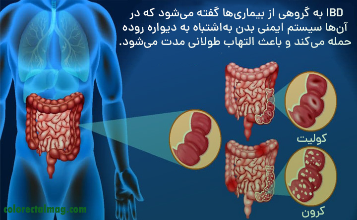 التهاب روده یا IBD