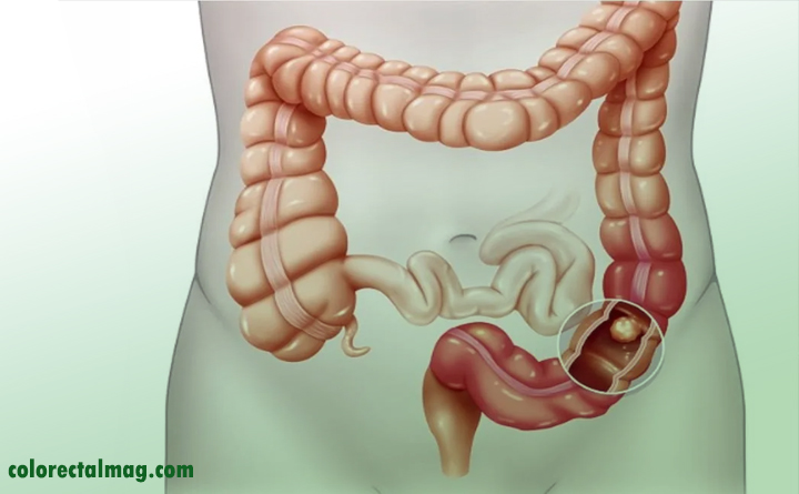 سرطان روده بزرگ