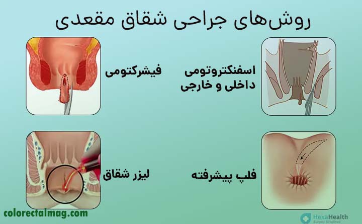 روش های درمان شقاق