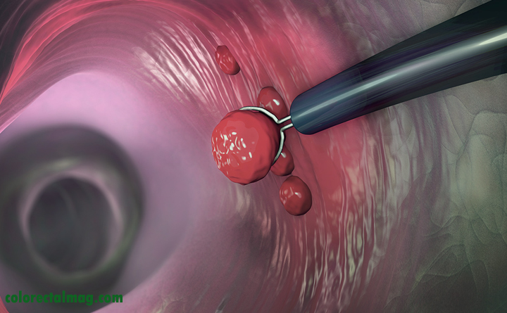 پولیپکتومی