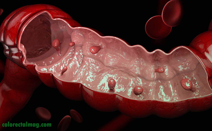 بیماری پولیپ روده