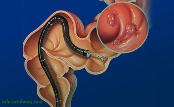 مزایا و معایب کولونوسکوپی