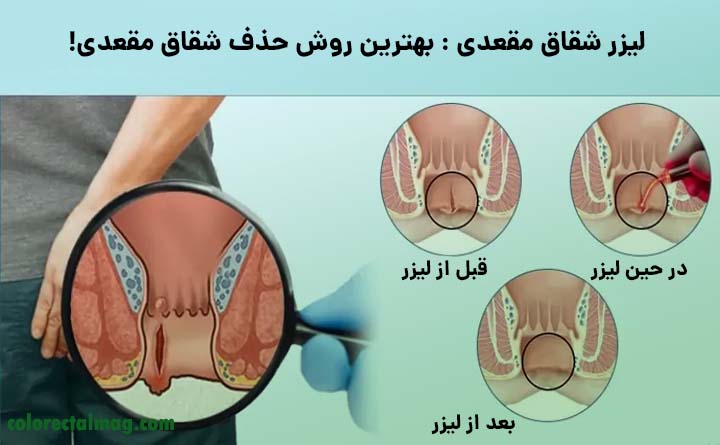 لیزر شقاق مقعدی
