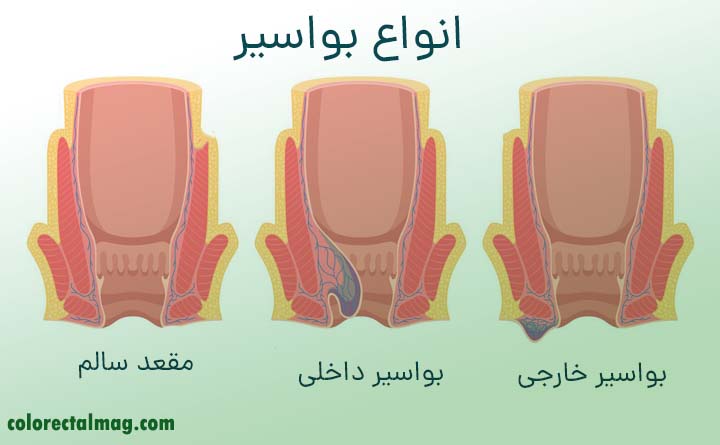 انواع بواسیر