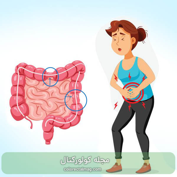 سندروم روده تحریک پذیر یا IBS چیست؟ علائم و درمان IBS 