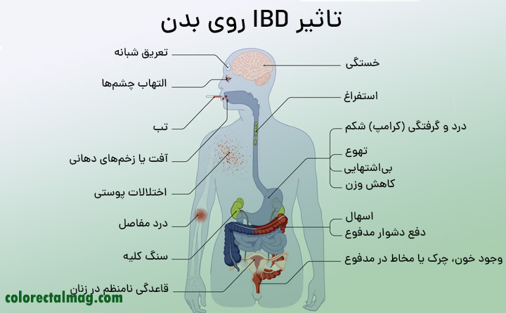 زندگی با التهاب روده