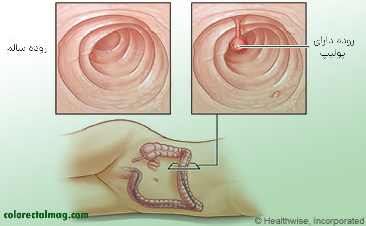 نشخیص با کولونوسکوپی