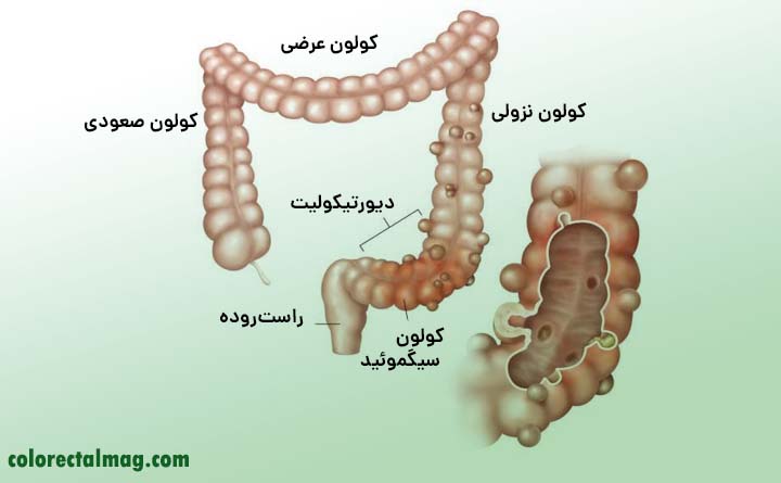 اسهال خونی چیست؟