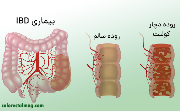 تشخیص بیماری IBD