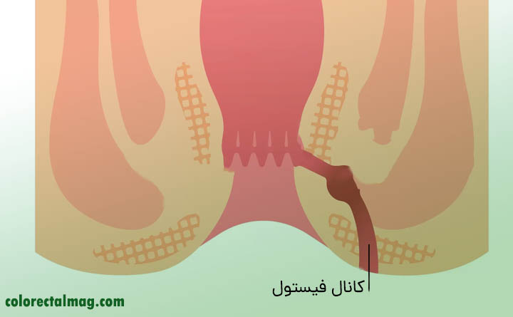 فیستول مقعدی