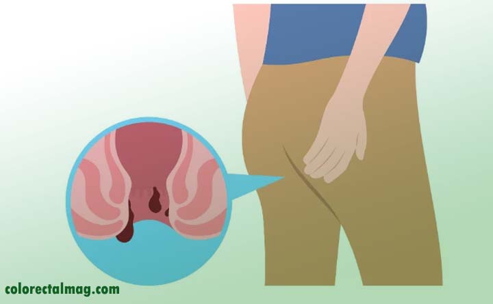 چرا بواسیر میگیریم؟