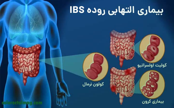 کولیت روده