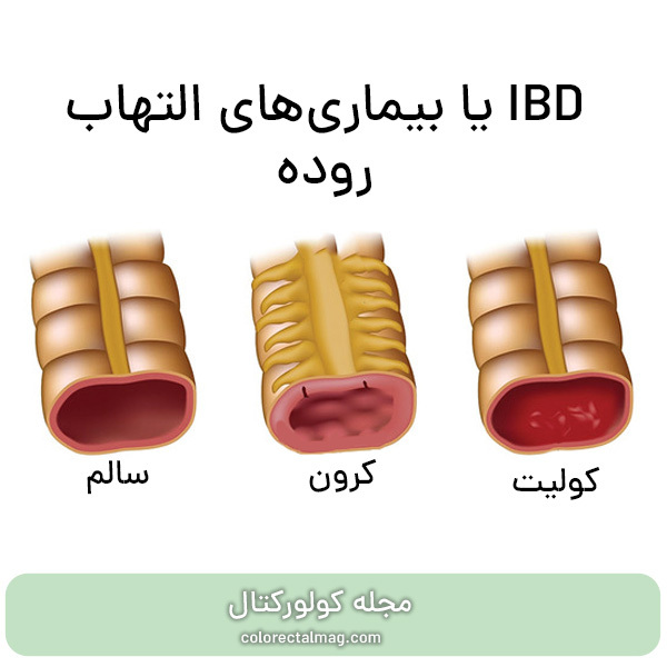 التهاب روده (IBD) چیست؟ علائم و روش درمان التهاب روده
