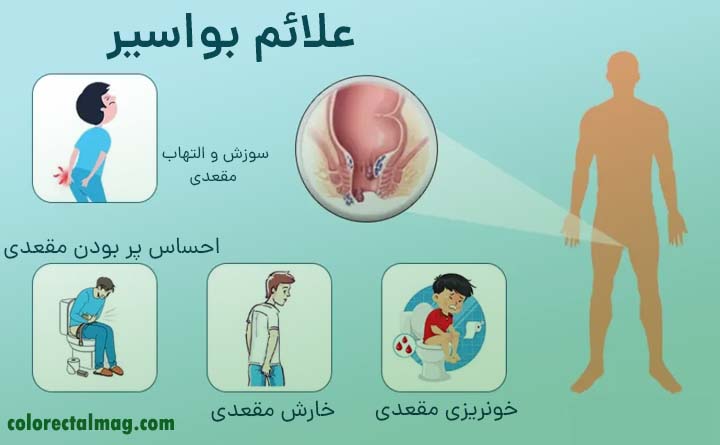 علائم بواسیر