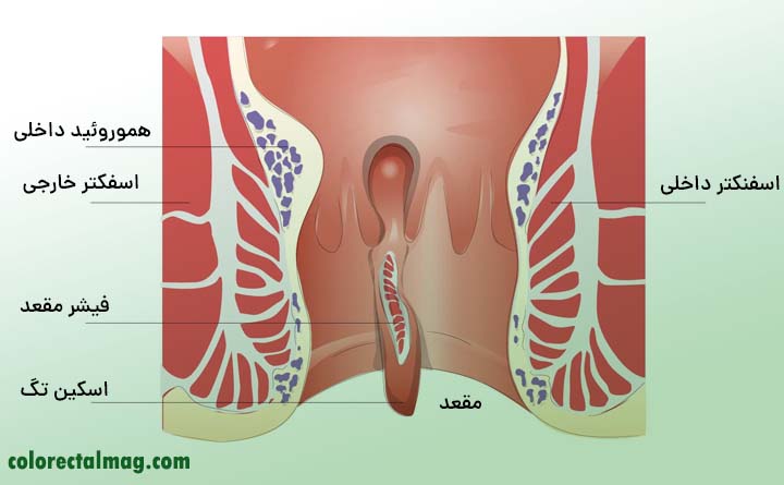 شقاق مقعدی چیست؟