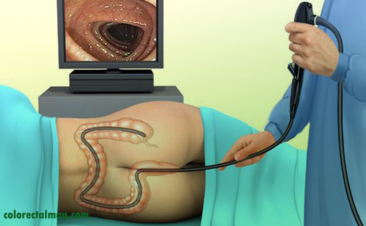 کولونوسکوپی چیست؟