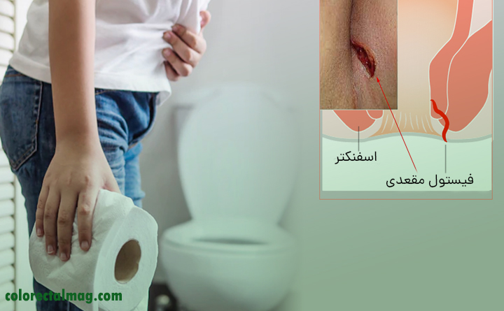 درمان فیستول مقعدی