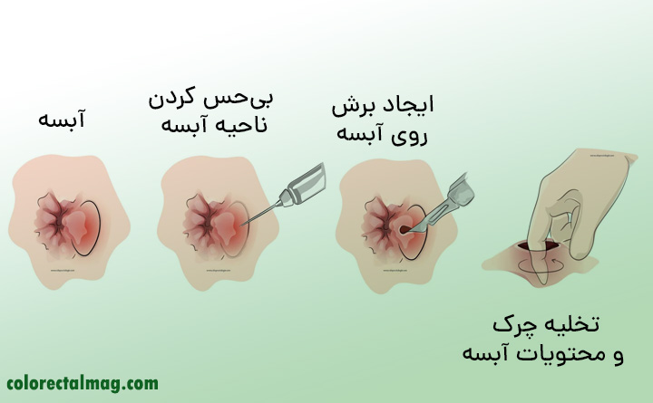 تخلیه آبسه