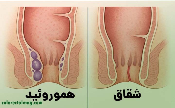 تفاوت بواسیر و شقاق