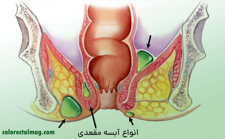 آبسه مقعدی