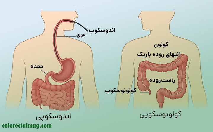 اندوسکوپی چه فرقی با کولونوسکوپی دارد