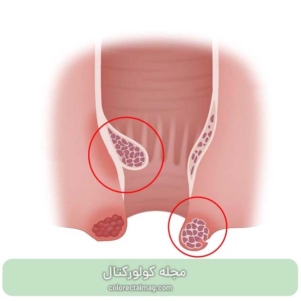بواسیر چیست؟ علائم، علل ابتلا و راه های پیشگیری و درمان آن