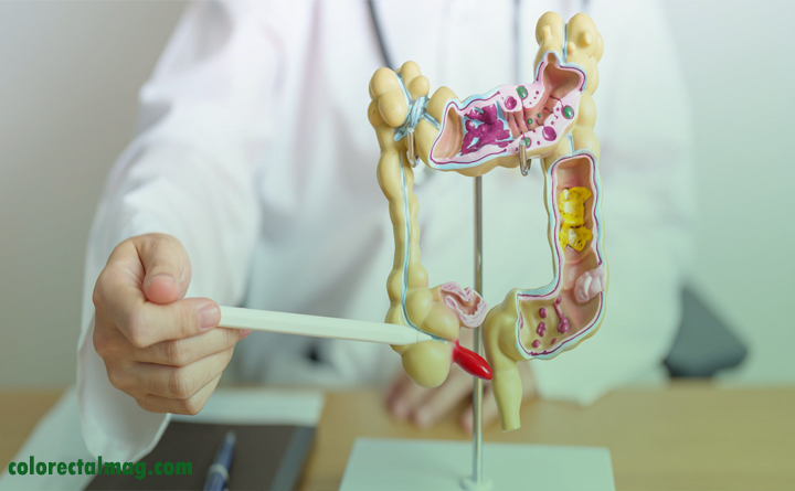 درمان پولیپ روده