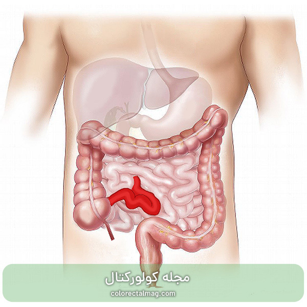 بیماری کرون روده - علائم، تشخیص و انواع روش درمان