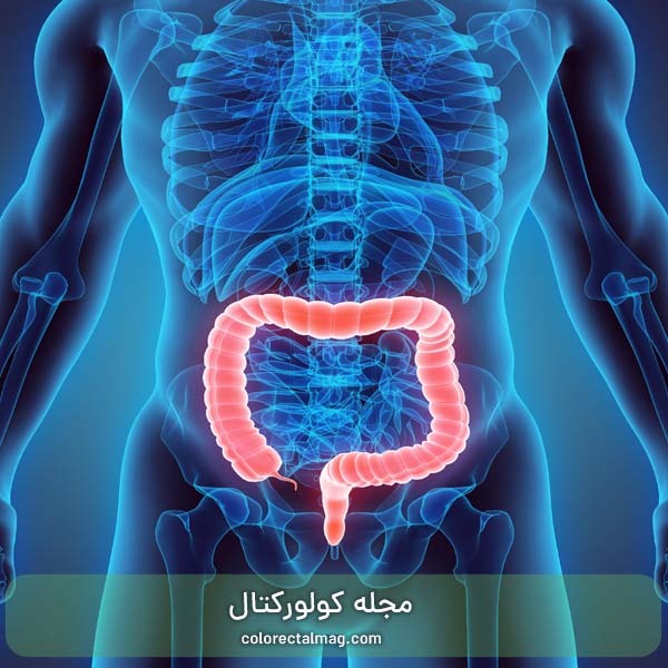 بیماری کولیت چیست و چگونه درمان می‌شود؟ 