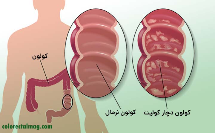 پیشگیری از کولیت روده