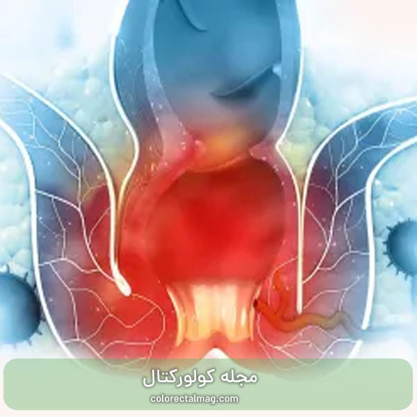 عفونت مقعدی + علائم و روش های درمان آن