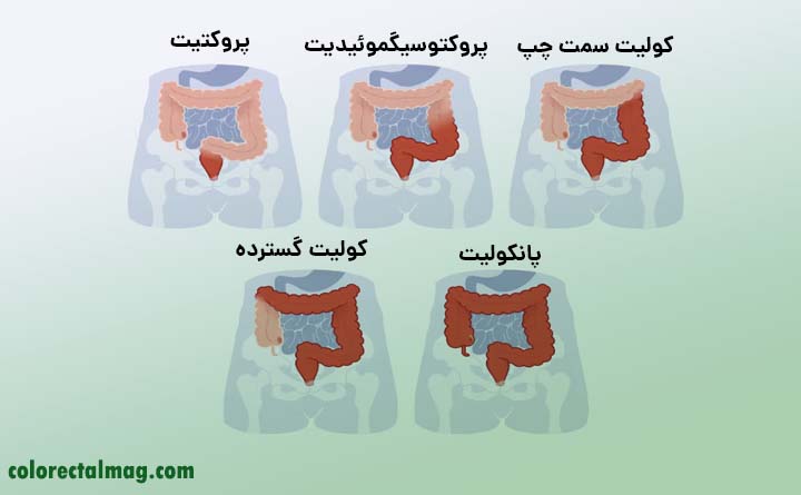 انواع کولیت روده